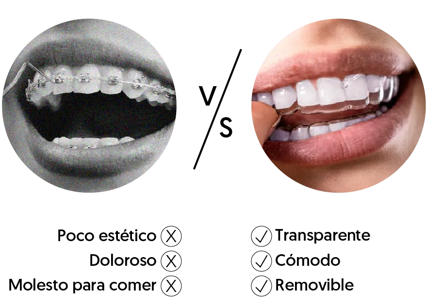 Explicacion de beneficios sobre ortodoncia invisible